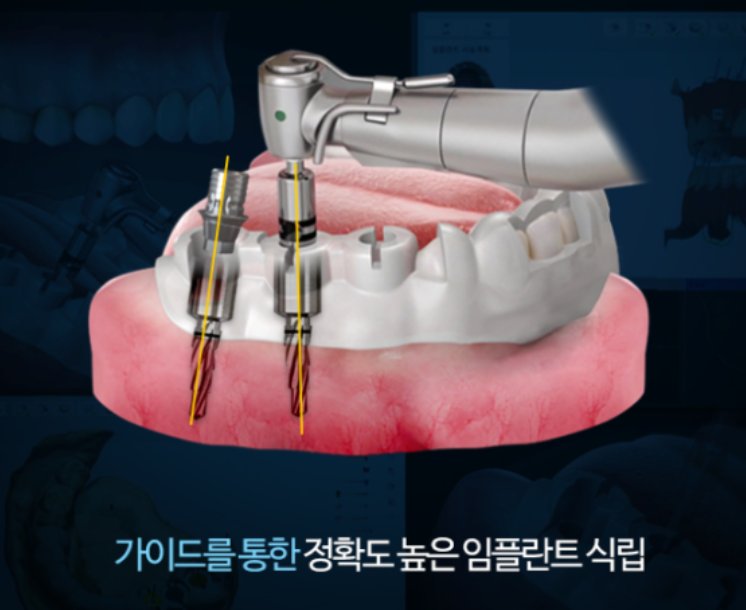 가이드를 통한 정확도 높은 임플란트 식립